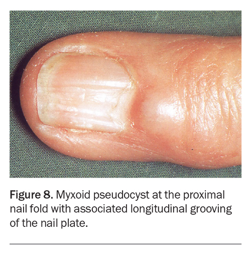 Evaluation and management of nail diseases Medicine Today